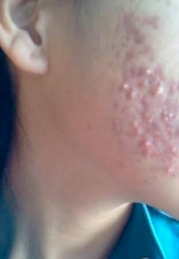 Mặt T.T bị nổi mụŮ
chi chít, sưng tấy sau khi trị liệu tại spa.