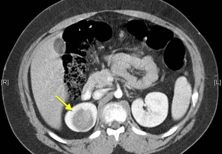 Hình ảnh khối u Wilms trên phim chụp cắt lớp.