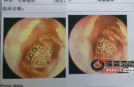Những đồ vật “kỳ dị” được lấy ra từ cơ thể người - 2 Nhện