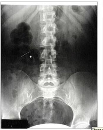 Những đồ vật “kỳ dị” được lấy ra từ cơ thể người - 16 Răng giả