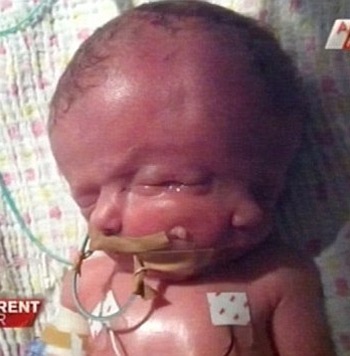 Em bé hai mặt đã qua đời