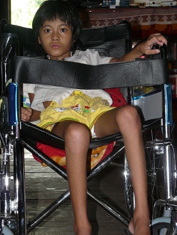 Theo các bác sỹ, bệnh của cháu H'Phôn khả năng để lại di chứng suốt đời rất cao.