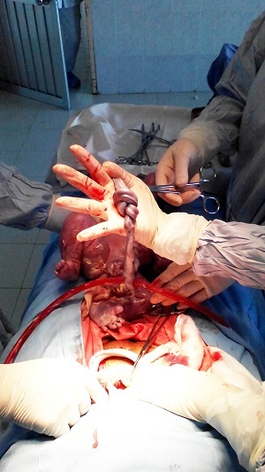 Dây rốn của thai nhi bị thắt nút.