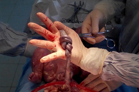 Cứu thành công trẻ sinh non bị thắt nút dây rốn