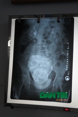 Khối thai đá của cụ Sáu.