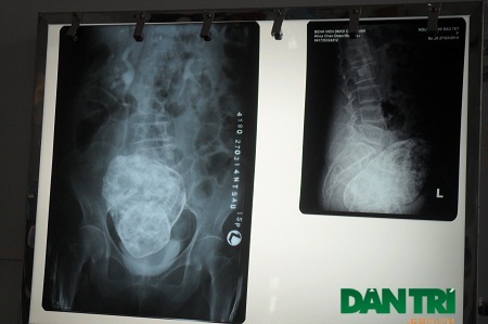 Khối thai đá của cụ Sáu.