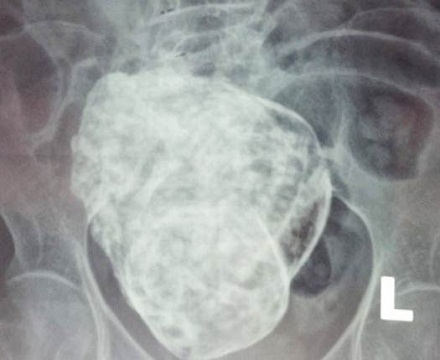 Hội chẩn liên viện trường hợp cụ bà mang “thai đá” gần 30 năm - 1 Hình ảnh khối thai đá của cụ Sáu