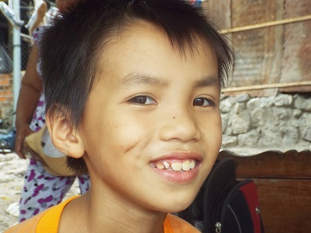 Vết khâu do bị ngã đập mặt vào đá của cháu Phong.