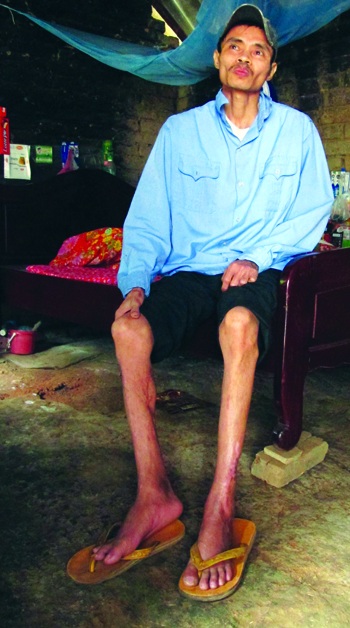 Anh Nga sau khi được bài báo cứu giúp, đã được tháo cùm, khỏi bệnh, khỏe mạnh, có nhà mới để ở.