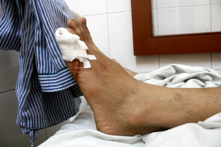 Xô xát với công an, một sinh viên bị đứt gân chân - 2 Ngón chân út bị đứt gân đã được phẫu thuật nối lại.