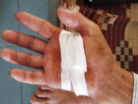 Nhập viện vì dằm gỗ dài ẩn trong tay... hơn 2 tháng - 1