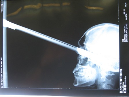 Bị kiếm đâm xuyên qua mắt 9,5cm vẫn thoát chết hy hữu - 1