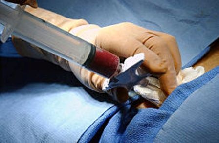 Nhiều ứng dụng “kinh ngạc” của tế bào gốc trong y học - 4 Lấy tế bào gốc tự thân từ chính cơ thể người bệnh ở phần tủy sống