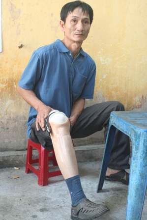 Anh Thuận với đôi chân giả vì phải cưa chân do ung thư