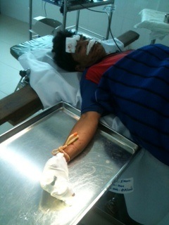  Bàn tay của anh Pét sau khi mổ