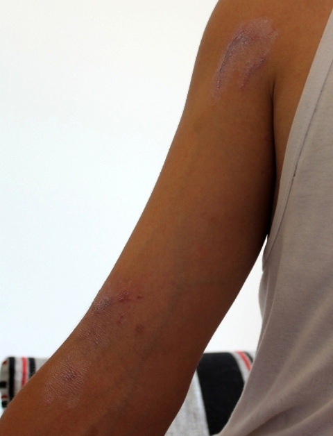 Kiến ba khoang tiếp tục tấn công chung cư cao tầng ở Huế - 1 Vết thương do kiến ba khoang gây ra ở trên tay anh Trần Văn Hòe