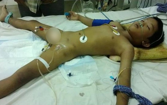 Nọc độc thấm vào nội tạng nên em cần phải lọc máu nhiều lần để giảm chất độc (Ảnh: Hoài Anh)