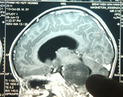 Khối u lớn ở não bệnh nhân