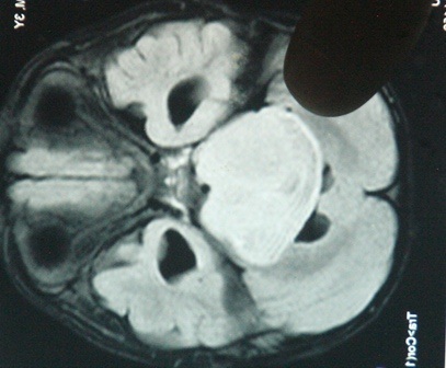Khối u lớn ở não bệnh nhân