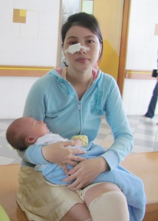 Chị Thu đang có con nhỏ bị côn đồ ném chai vào mặt đến vỡ hốc mắt, rạn xương gò má
