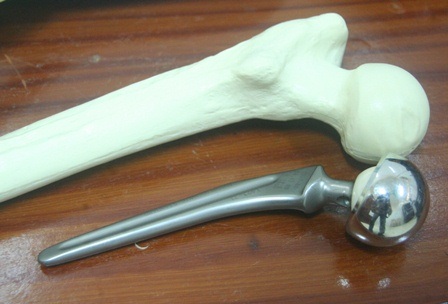 Cụ ông 100 tuổi được thay khớp háng thành công - 3 Phần xương khớp háng (mô hình phía trên) và phần thay thế (dưới) được đưa vào trong xương khớp háng