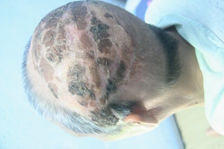 Điều trị lành tổn thương do ung thư da đầu diện rộng 10 năm hiếm gặp