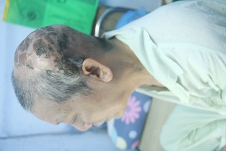 Điều trị lành tổn thương do ung thư da đầu diện rộng 10 năm hiếm gặp