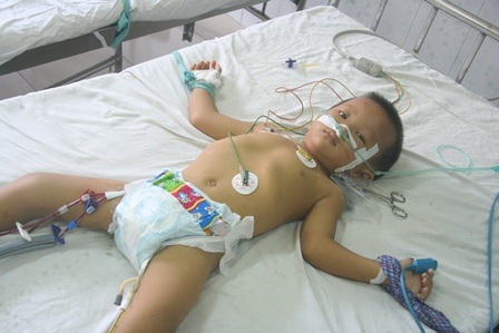 Cháu bé 3 tuổi bị ong vò vẽ đốt đang nguy kịch trên giường bệnh - 1 Toàn thân cháu Trọng có màu vàng khè do độc tố của ong làm tổn thương gan rất nặng