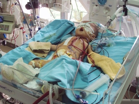 Cháu Chiến nằm hôn mê với các dây chuyền thuốc chằng chịt khắp người