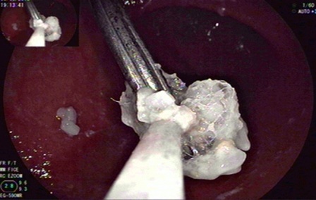 Bé 2 tuổi nuốt cây đinh sắt dài 5cm vào bụng - 1 Cây đinh trong dạ dày cháu Q. đã được lấy qua phương pháp n