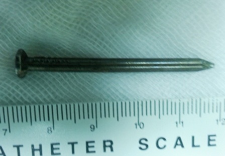 Bé 2 tuổi nuốt cây đinh sắt dài 5cm vào bụng - 2 Cây đinh đo dài gần 5cm