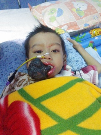 Khối u trên miệng cháu Huy đã đỡ hơn - 2 Khối u trên miệng Huy đã đỡ hơn lúc trước nhiều