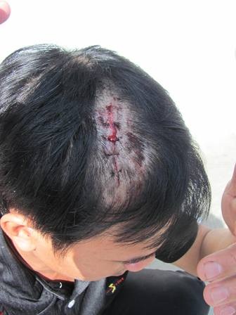 Côn đồ xông vào bến xe chém trọng thương bảo vệ - 1 Anh Lộc bị chém thương tích trên đầu