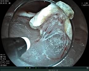 Tổn thương ung thư dạ dày sớm đang được phẫu tích