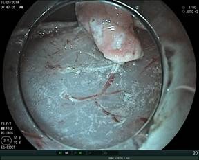 Tổn thương ung thư dạ dày sớm đang được phẫu tích