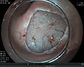 Vết loét sau phẫu tích tổn thương ung thư dạ dày sớm và tổn thương ung thư sau khi được cắt bỏ.