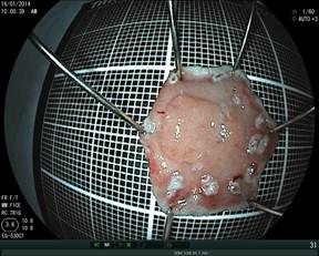 Vết loét sau phẫu tích tổn thương ung thư dạ dày sớm và tổn thương ung thư sau khi được cắt bỏ.