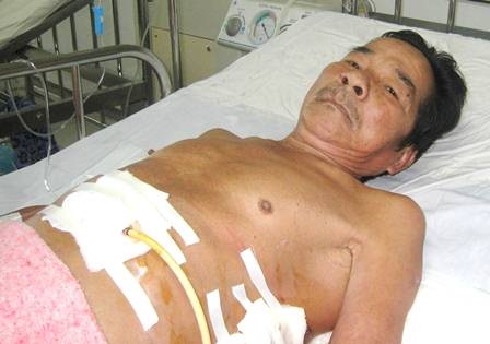 Suýt tử vong vì xương gà đâm thủng thực quản, phế quản - 1 Nạn nhân Sự được cứu sống sau khi suýt tử vong vì xương gà