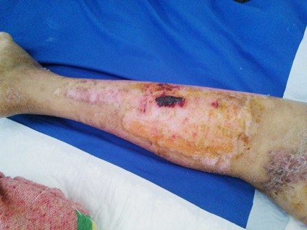 Người đàn bà bị mất gần hết da đã đỡ rất nhiều - 1 Phần da chân của chị Huế đang hồi phục tốt