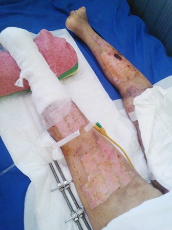 Người đàn bà bị mất gần hết da đã đỡ rất nhiều - 2 Phần da chân của chị Huế đang hồi phục tốt