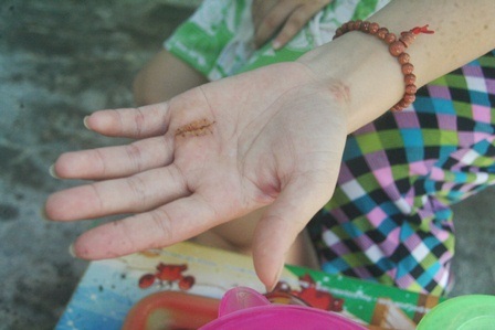 Vết mổ 2 lần trên bàn tay chị Hồng