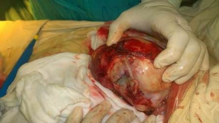 Thai ký sinh trong bụng trẻ 2 tháng tuổi