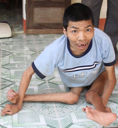 Da cam - nỗi đau bao giờ nguôi ngoai! - 2 Da cam - nỗi đau bao giờ nguôi ngoai! - 2