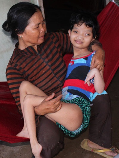 Da cam - nỗi đau bao giờ nguôi ngoai! - 3 Da cam - nỗi đau bao giờ nguôi ngoai! - 3