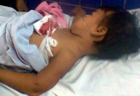 Cháu bé 2 tuổi nguy kịch vì lưỡi máy mài đâm vào ngực  - 1