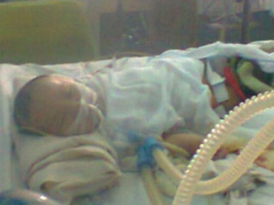 Bé 2 tháng tuổi bị cắt hơn 1m ruột - 1