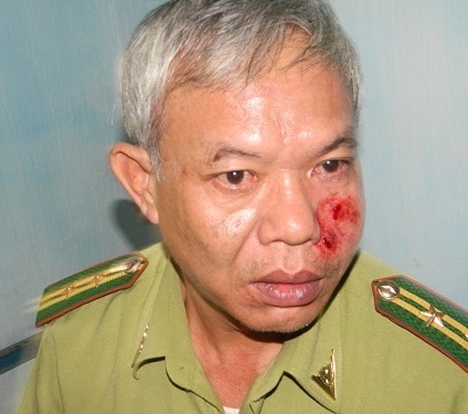 Chủ buôn gỗ lậu chém vào mặt cán bộ kiểm lâm - 1 Chủ buôn gỗ lậu chém vào mặt cán bộ kiểm lâm - 1