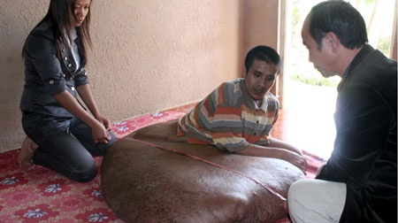 Người đàn ông mang khối u khổng lồ nặng 80kg - 1 Người đàn ông mang khối u khổng lồ nặng 80kg - 1