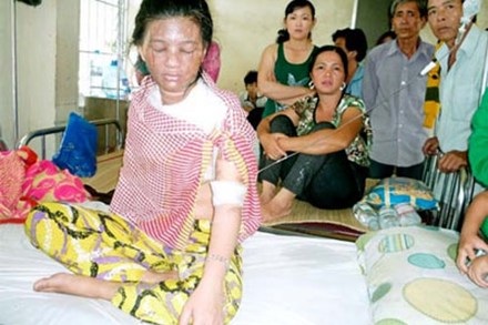 Chị Thy với vết bỏng khắp người