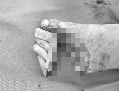 Nắp pô xe “sát thủ” nhan nhản ngoài đường - 3 Vết thương kinh hoàng của cháu L sau khi chạm vào tấm chắn pô xe. Ảnh: BS Giang cung cấp.